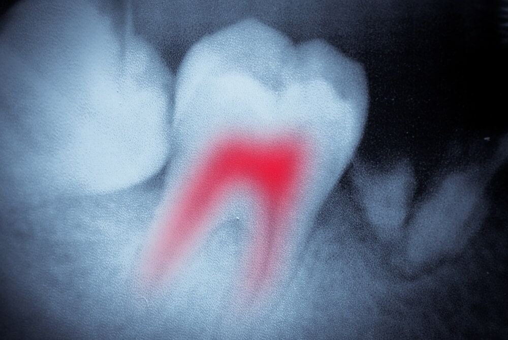 endodontist Endodontics